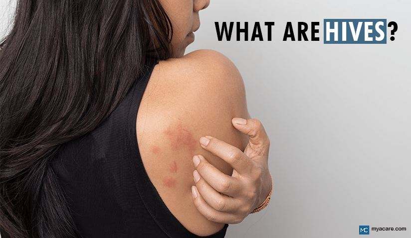 WHAT IS URTICARIA (HIVES)