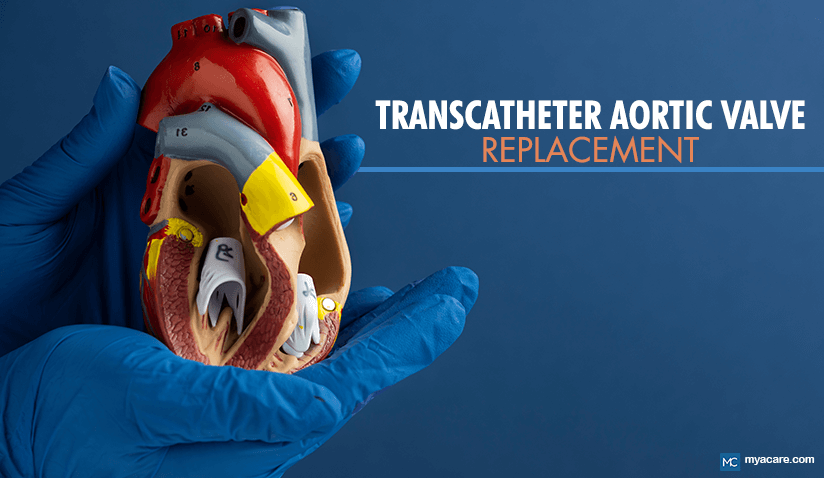 TRANSCATHETER AORTIC VALVE REPLACEMENT (TAVR): AN OPEN HEART ALTERNATIVE 