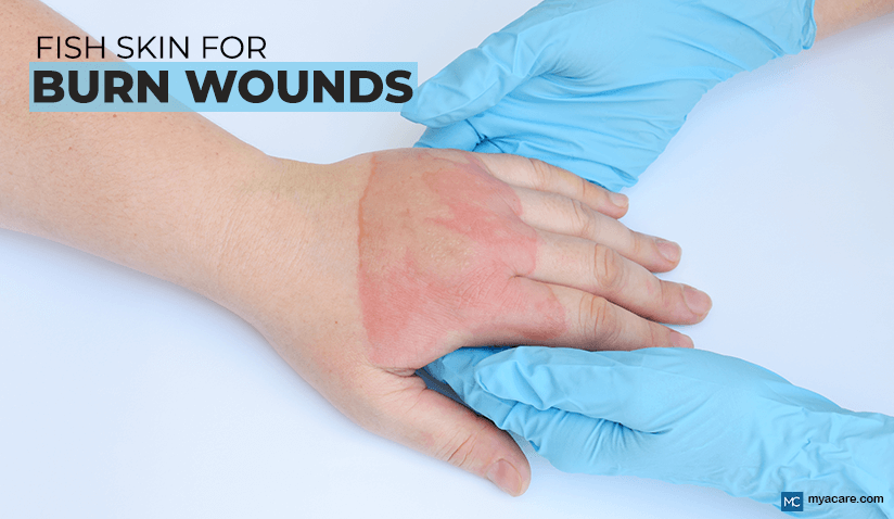 FISH SKIN FOR BURN WOUNDS: THE FUTURE WOUND DRESSING? 