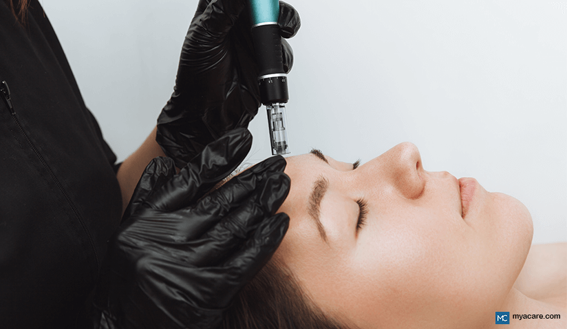 RADIOFREQUENCY MICRONEEDLING - THE REGENERATIVE BOOST YOUR SKIN NEEDS