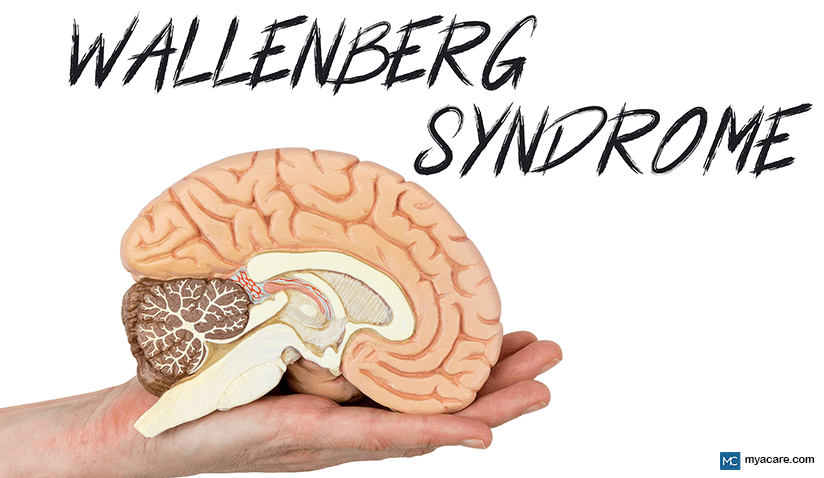 WALLENBERG SYNDROME – SYMPTOMS, CAUSES, RISK FACTORS, AND TREATMENT