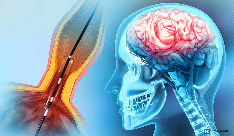 INTERVENTIONAL NEURORADIOLOGY: APPLICATIONS, RISKS, LATEST ADVANCEMENTS, AND MORE