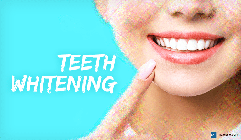 TEETH WHITENING: THINGS ONE SHOULD KNOW