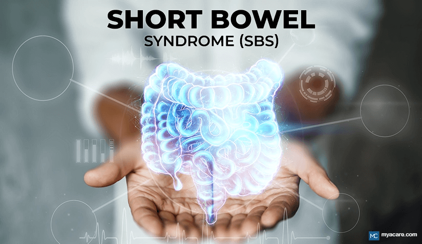 UNDERSTANDING SHORT BOWEL SYNDROME (SBS): CAUSES, SYMPTOMS, AND TREATMENT