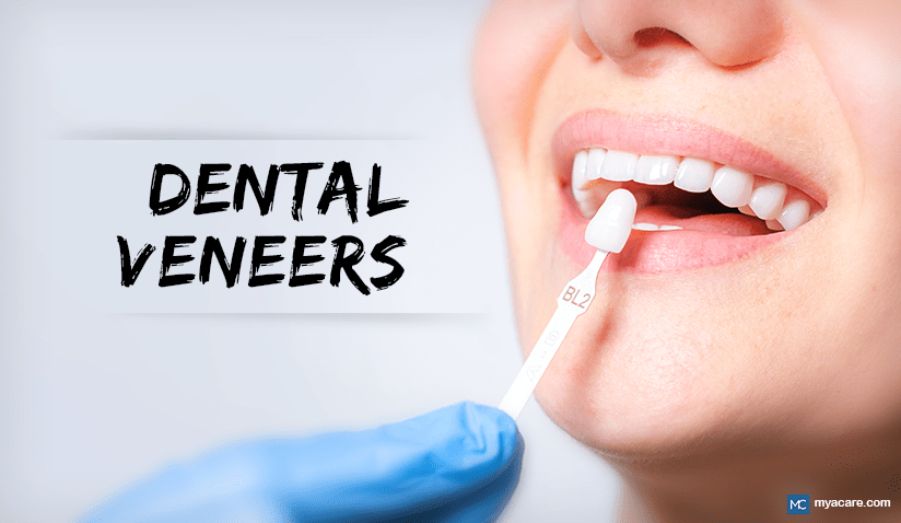 DENTAL VENEERS- TYPES, BENEFITS, AND COSTS