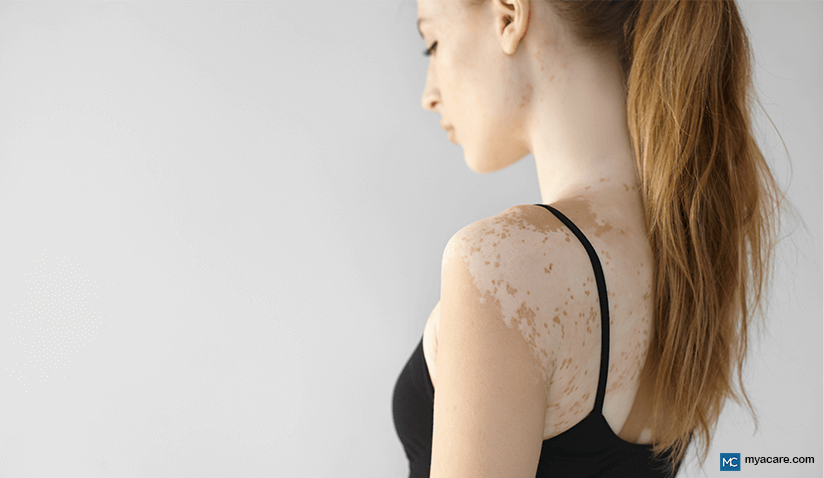 WHAT IS VITILIGO