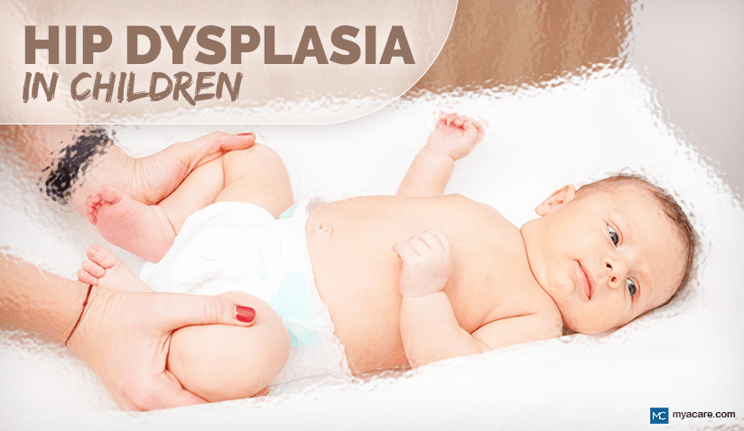 DEVELOPMENTAL DYSPLASIA OF THE HIP - HIP DYSPLASIA IN CHILDREN