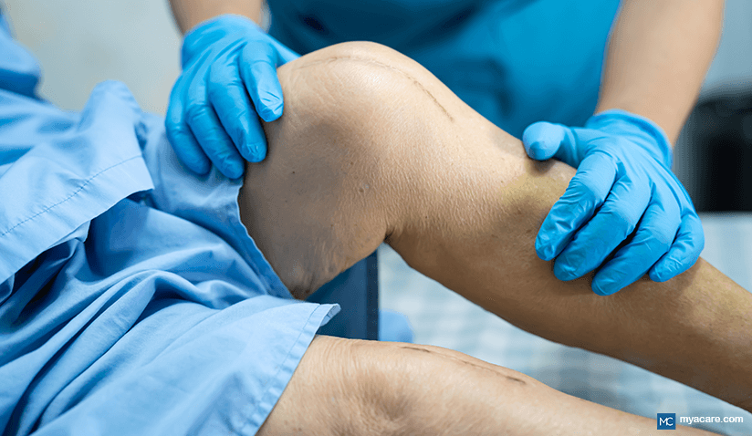 BENEFITS OF PHYSIOTHERAPY AFTER JOINT REPLACEMENT SURGERY