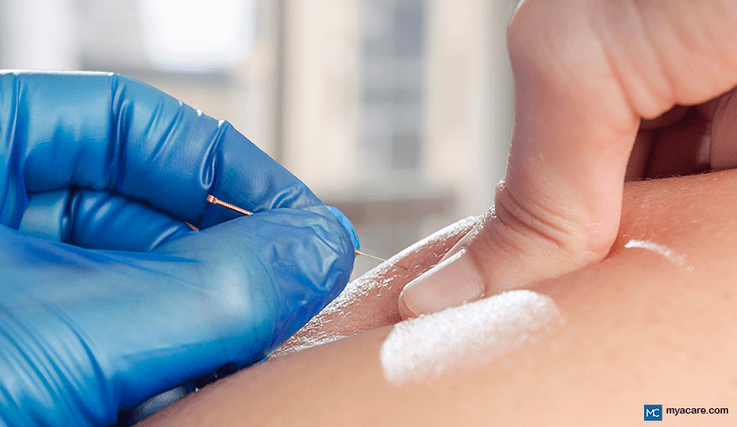 BENEFITS OF DRY NEEDLING FOR MUSCLE PAIN