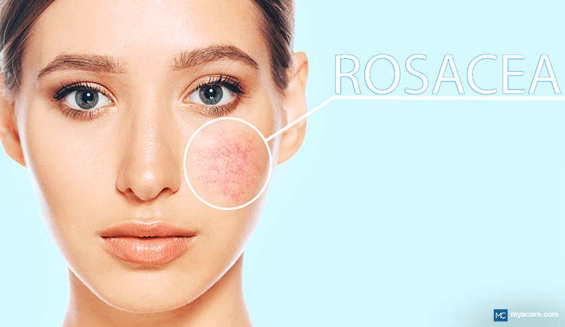 ROSACEA: WHAT YOU NEED TO KNOW