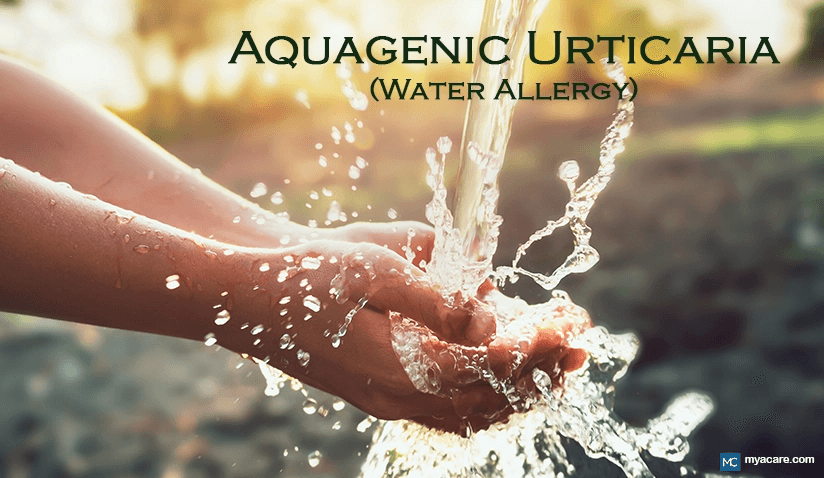 UNDERSTANDING AQUAGENIC URTICARIA (WATER ALLERGY): SYMPTOMS, CAUSES AND MANAGEMENT