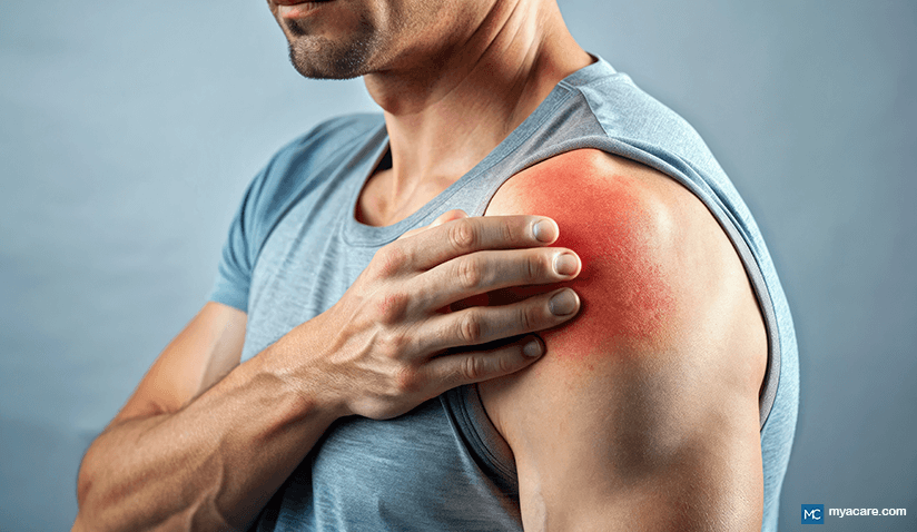 ROTATOR CUFF SYNDROME: SYMPTOMS, DIAGNOSIS, AND TREATMENT