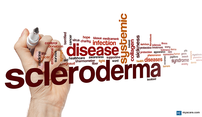 SCLERODERMA: MORE THAN JUST A SKIN DISEASE  