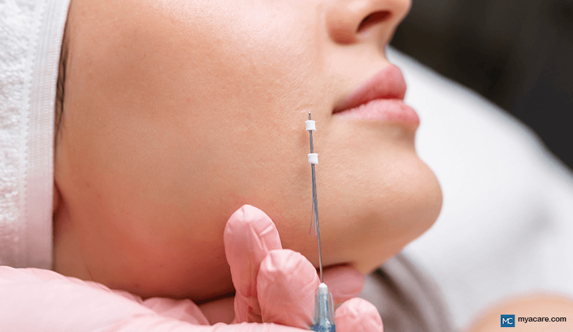 THREAD LIFTS – A MINIMALLY INVASIVE ALTERNATIVE TO FACELIFT SURGERY