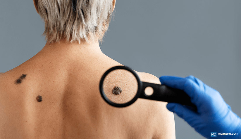 MELANOMA: DEFINITION, DIAGNOSIS, AND TREATMENT