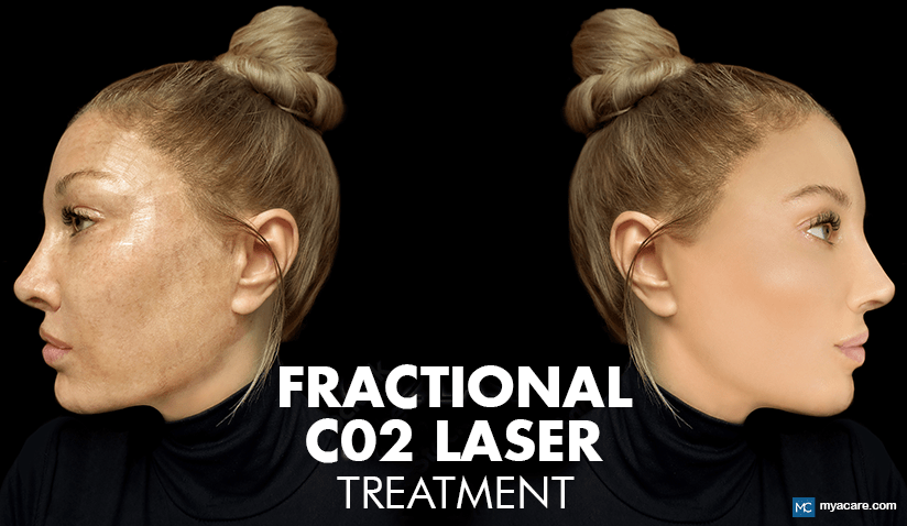 FRACTIONAL CO2 LASER: A GUIDE TO SKIN RESURFACING AND RENEWAL