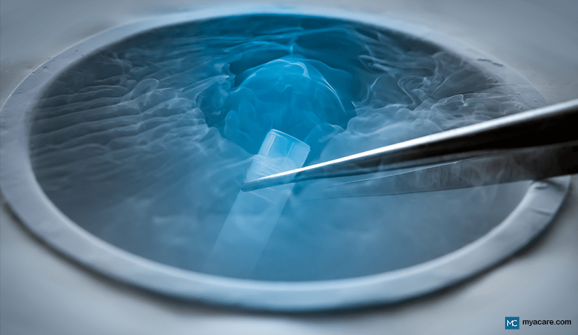 OVARIAN TISSUE FREEZING (CRYOPRESERVATION)