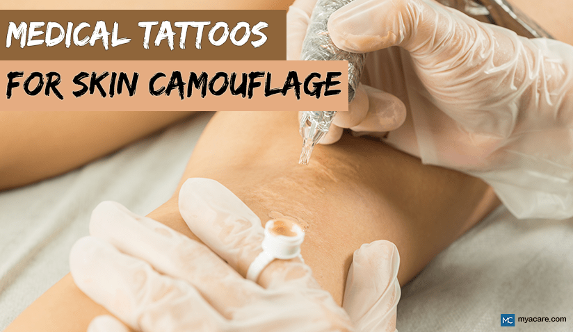 MEDICAL TATTOOS FOR SKIN CAMOUFLAGE: BENEFITS, RISKS AND ALTERNATIVE OPTIONS