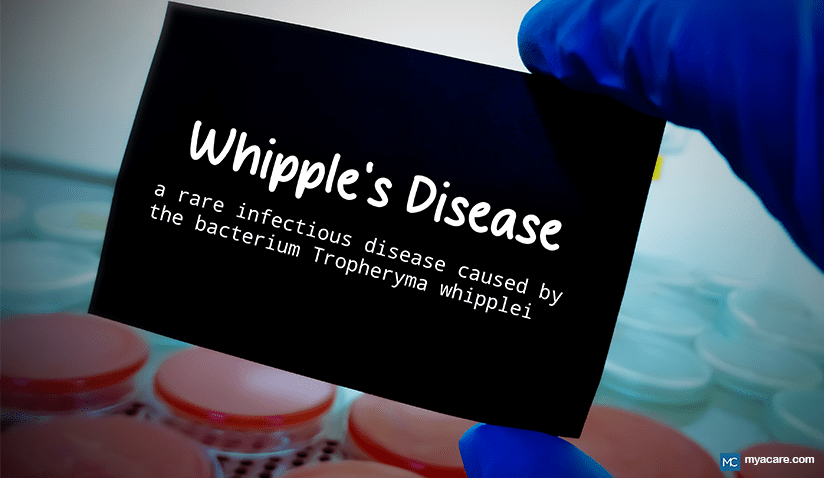 UNDERSTANDING WHIPPLE’S DISEASE: TRANSMISSION, SYMPTOMS, AND TREATMENT OPTIONS