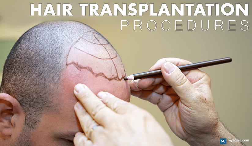 HAIR TRANSPLANTATION PROCEDURES