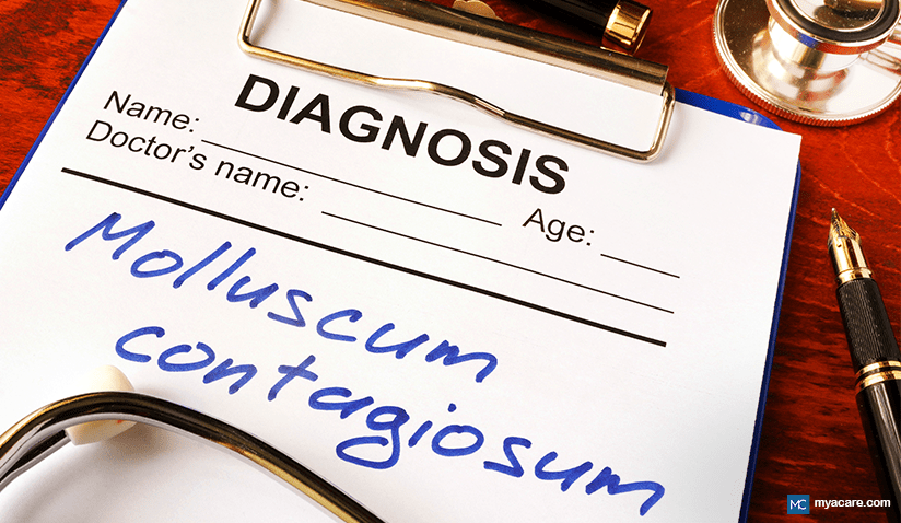 MOLLUSCUM CONTAGIOSUM