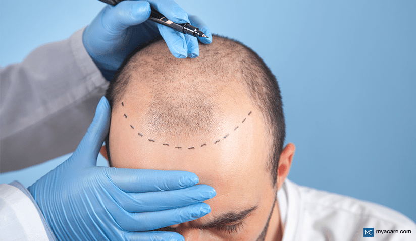 HOW ROBOTICS AND AI ARE REVOLUTIONIZING HAIR TRANSPLANTATION 