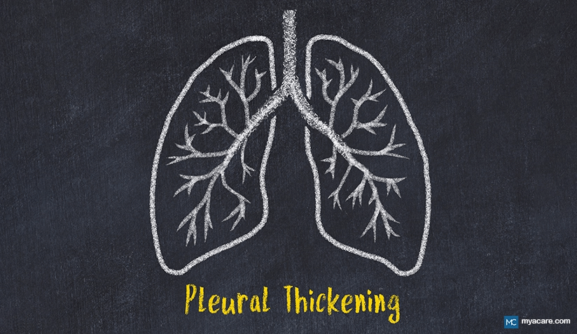 WHAT CAUSES PLEURAL THICKENING? SYMPTOMS, DIAGNOSIS, LATEST IN TREATMENT