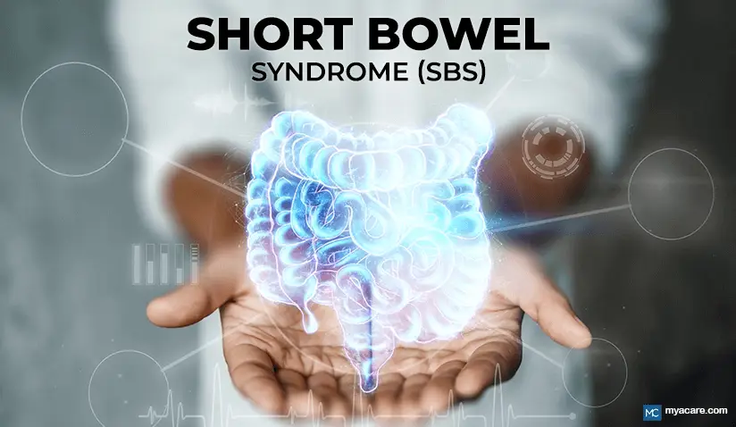 UNDERSTANDING SHORT BOWEL SYNDROME (SBS): CAUSES, SYMPTOMS, AND TREATMENT