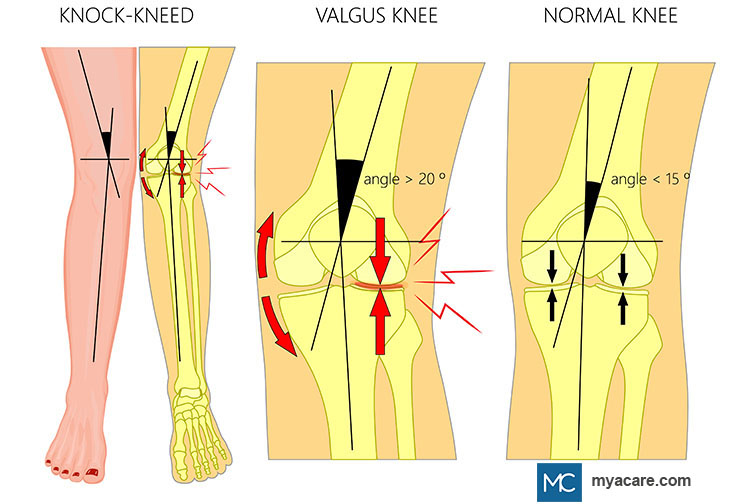 Plain and anatomical knee view of Genu Valgum, Knee angle in the Valgus Knee ( > 20°) versus the Normal Knee ( < 15°)