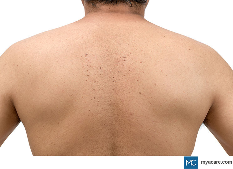 Seborrheic keratoses macules on the back