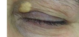 Xanthelasma deposit