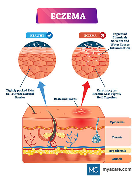 Cross section of skin shows area of healthy skin and area of inflammatory Eczema rash and flakes triggered by allergens