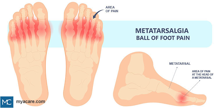 Area of pain at the head of the metatarsal in the ball of the foot - frontal and side view