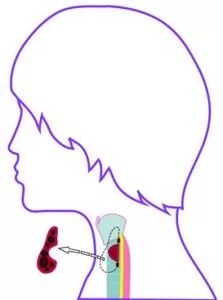 SUBTOTAL FLAP RESECTION: Subtotal flap resection leaves a thyroid remnant of 1-4 grams.