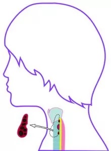 NEAR-TOTAL FLAP RESECTION: In near-total flap resection, even more abnormal thyroid tissue is removed. Less than 1 gram remains.