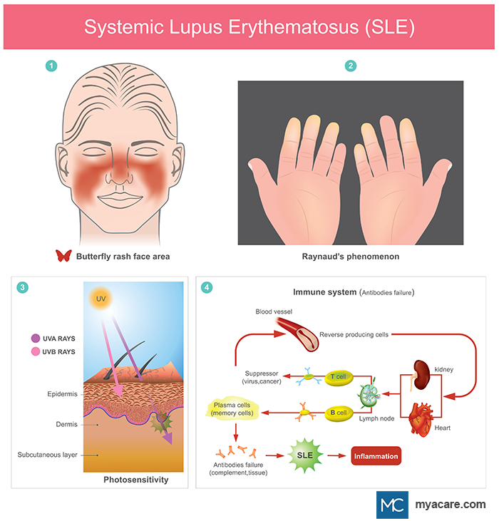 1.Rash on face; 2.Reduced blood flow to fingers; 3.Exposure to UV radiation; 4.Failed immune system (antibodies) workflow