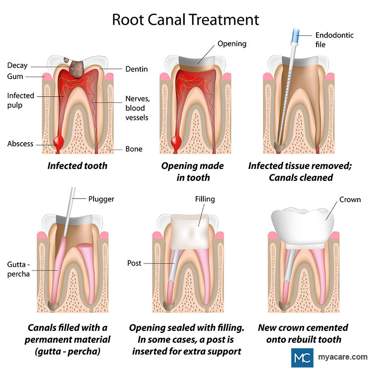 Steps in root canal treatment showing infected tooth, removal of infected tissue, filling of canal, sealing and new crown