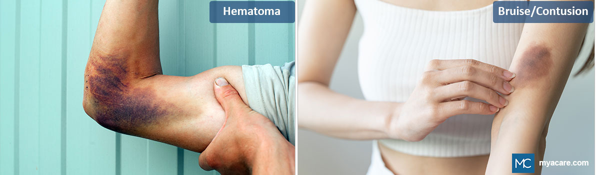 Hematoma(L)-raised,swollen area due to localized blood collection; Bruise/Contusion(R)-flat, discolored area on the skin