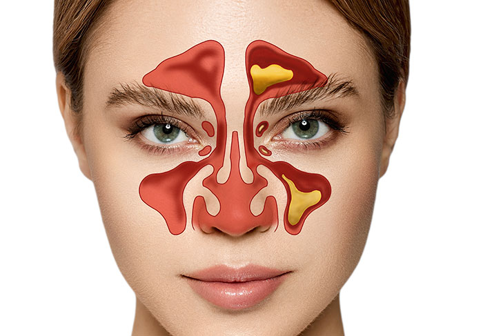 Sinuses - small air-filled spaces behind facial bony structures. Left Paranasal and frontal sinuses seen clogged with mucus.