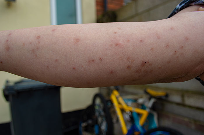 Bed bug bites - clusters of red bumps on the skin, some blisters as well seen with a dark spot in the center