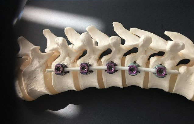 Illustration of the VBT System Reflect on the spine model