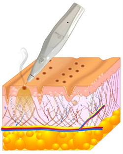 Depth penetration of Plexr Pro treatment into the layers of the skin