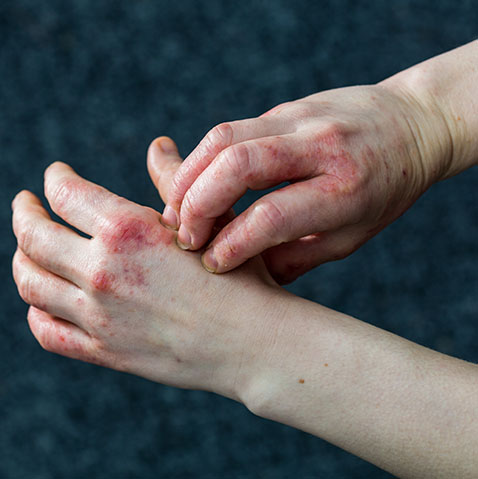 Red skin on knuckles of both hands, person scratching the itchy skin