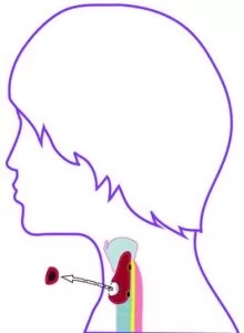 NODAL EXCISION: Excising abnormal tissue with a fringe of healthy tissue.