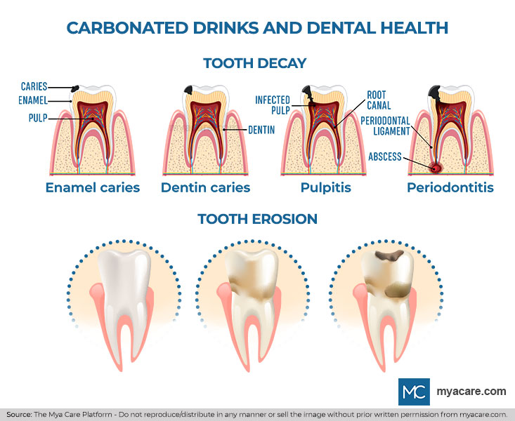 Effects of carbonated drinks on teeth: tooth decay, caries, infected pulp, pulpitis, abscess, periodontitis and tooth erosion