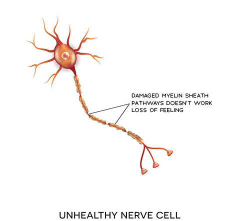 Unhealthy Nerve Cell - Damaged Myelin sheath, pathways don't work leading to loss of feeling 