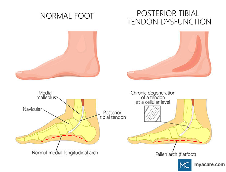 Comparison of normal foot vs posterior tibial tendon dysfunction which shows chronic degeneration of tendon and fallen arch