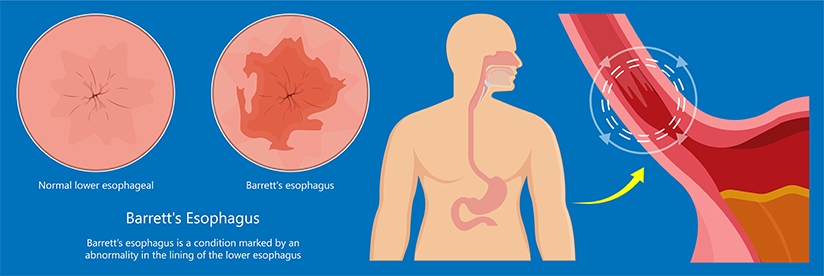 Normal lower esophagus, Lower esophagus in Barrett's esophagus and location of the lesion in the digestive system